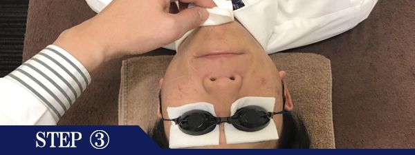 あごヒゲ脱毛Step3