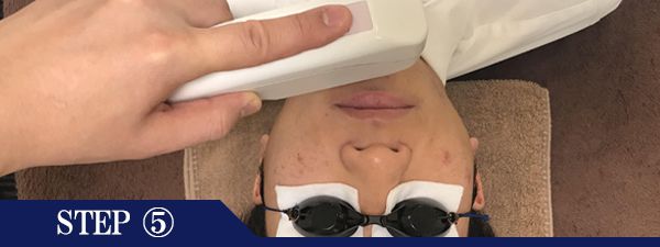 あごヒゲ脱毛Step5