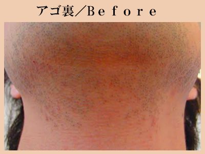 あご裏の脱毛前