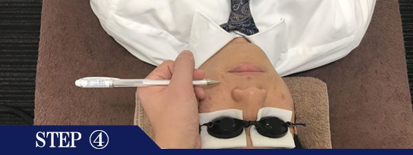 鼻下ヒゲ脱毛Step4