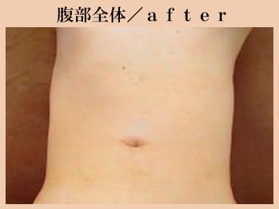 腹部の脱毛後