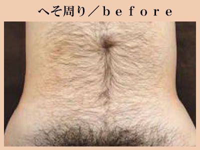 へそ周り脱毛前