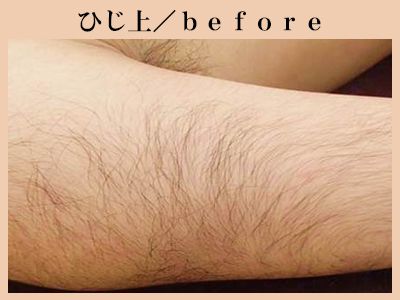 ひじ上の脱毛前