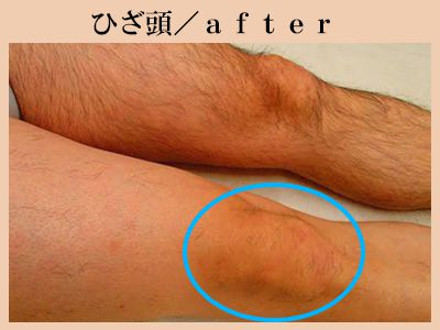ひざ頭の脱毛後