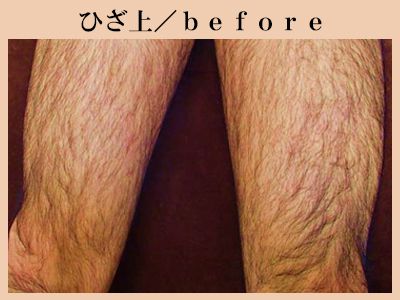 ひざ上の脱毛前
