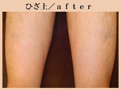ひざ上の脱毛後