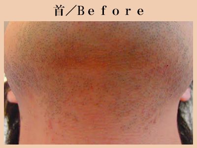 首の脱毛前