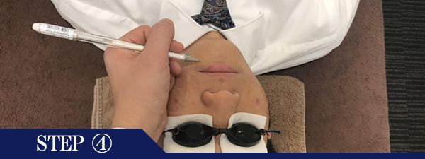 口下ヒゲ脱毛Step4