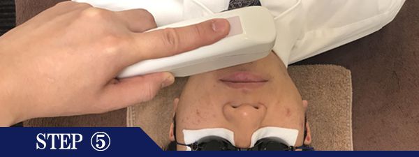 口下ヒゲ脱毛Step5