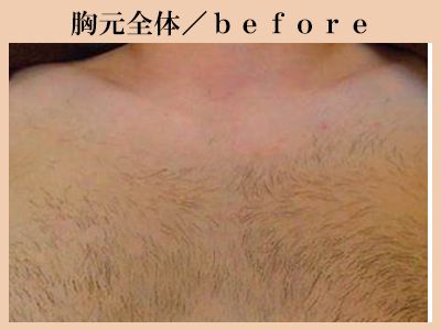 胸元の脱毛前
