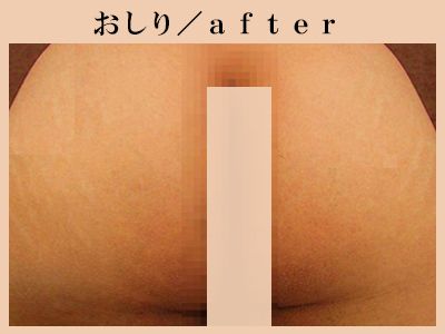 おしりの脱毛後