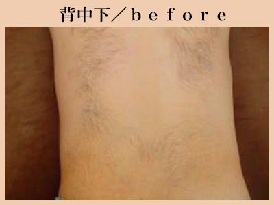 背中下の脱毛前