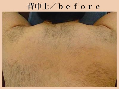 背中上の脱毛前