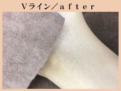 Vラインの脱毛後