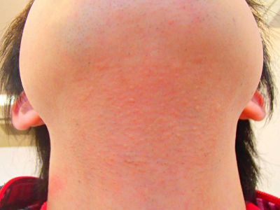 ヒゲ脱毛効果後