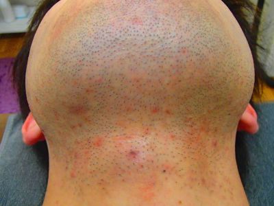 ヒゲ脱毛効果前