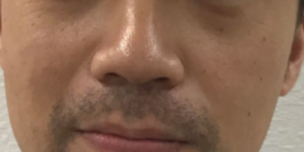 ヒゲ脱毛効果前