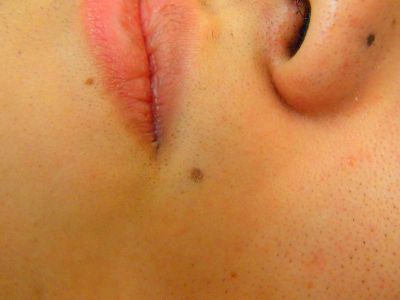 ヒゲ脱毛効果後