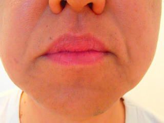 ヒゲ脱毛効果後