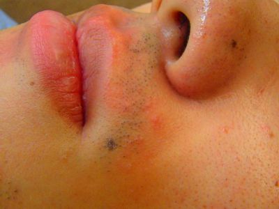 ヒゲ脱毛効果前