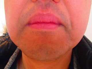 ヒゲ脱毛効果前