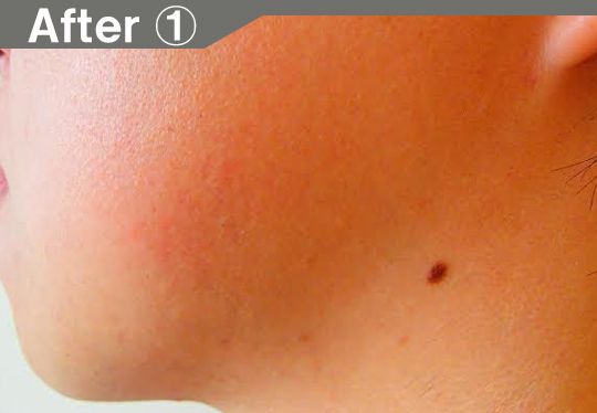 アゴ、ほほ、もみあげのデザインヒゲ脱毛の効果after