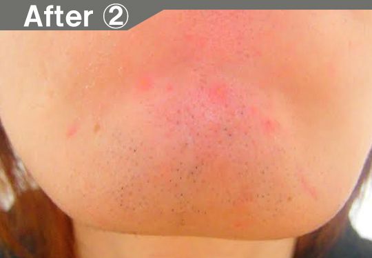 アゴ裏、首のヒゲ脱毛効果after