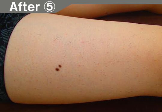 口周りのヒゲ脱毛効果after