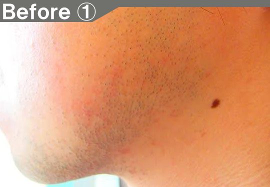 アゴ、ほほ、もみあげのデザインヒゲ脱毛の効果before