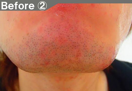 アゴ裏、首のヒゲ脱毛効果before