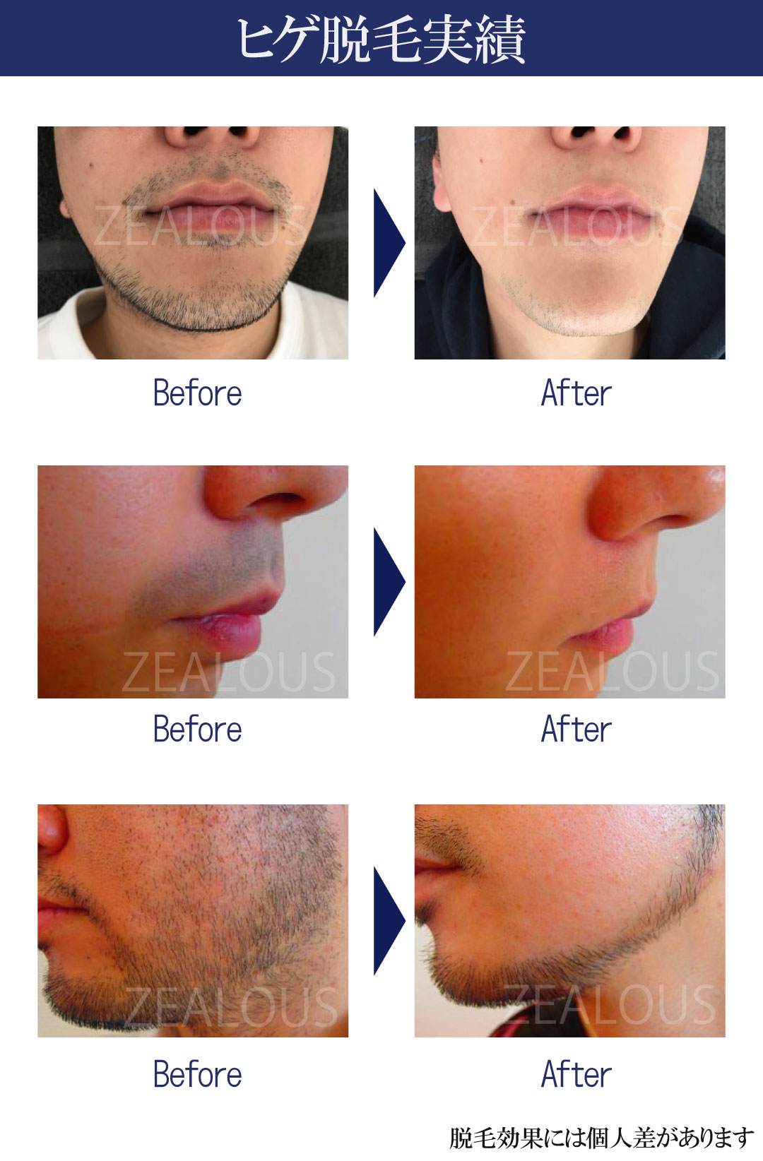 ヒゲ脱毛半年フルーパスキャンペーン_脱毛実績